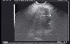 EUS-FNA of pancreatic cancer