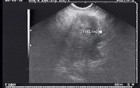 EUS-FNA of pancreatic cancer