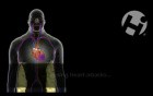 Atherosclerosis