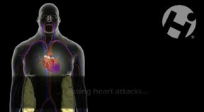Atherosclerosis
