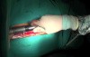 Median Sternotomy - Cardiac Surgery