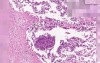 Small Cell Carcioma - Histopathology - Lung
