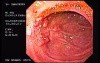 Duodenal Ulcers and Erosions (3 of 3)