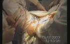 Rectum Cancer Surgery