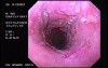 Barrett´s Esophagus (3 of 4)
