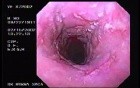 Barrett´s Esophagus (3 of 4)
