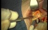 Rebuild Of Madnibular Implant Site (1/4)