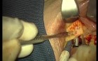 Rebuild Of Madnibular Implant Site (1/4)