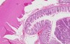 Adenocarcinoma - Histopathology - Colon