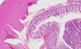 Adenocarcinoma - Histopathology - Colon