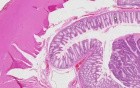 Adenocarcinoma - Histopathology - Colon