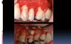 How To Aplicate Emdogain (Part 1)