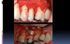 How To Aplicate Emdogain (Part 1)