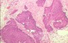 Perforation of a Esophageal Carcinoma after the procedure
 with hydrostatic balloon dilation (10 of 12)