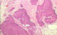Perforation of a Esophageal Carcinoma after the procedure
 with hydrostatic balloon dilation (10 of 12)