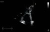 Echocardiography - Moderator Band