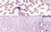 Blood - Acute Leukemia
