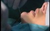 Chin enhancement - Serdev Technique