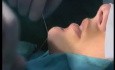 Chin enhancement - Serdev Technique