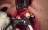 Implant Surgery, #11 Site - ID Screwplant System, Mineross Regenerated Bone