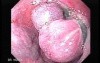 Esophageal Variceal Bleeding - Varices After Ligation