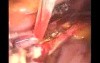 Controle Of Uterine Artery Bleeding During Hysterectomy