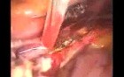 Controle Of Uterine Artery Bleeding During Hysterectomy