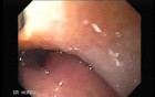 Uvula with Herpes