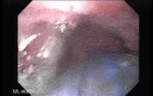 Achalasia - Guidewire For Esophageal Dilation - 4/4