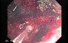 Tubulo - Villous Rectal Adenoma - Endoscopy (35 of 35)