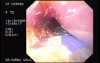 Esophageal Achalasia  (6 of 16)