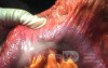 Endoscopic Image of Adenocarcinoma of the Transverse Colon (4 of 9)