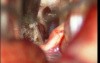 Brain Stem Tumor - Pontine Glioma - Microsurgical Removal