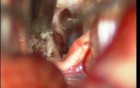 Brain Stem Tumor - Pontine Glioma - Microsurgical Removal