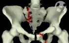 Volumated Pelvis