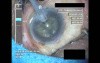 Cataract Surgery VII - Part 3