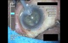 Cataract Surgery VII - Part 3