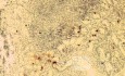 Gastric lymphoma with metastases to the duodenum (14 of 15)