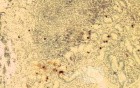Gastric lymphoma with metastases to the duodenum (14 of 15)