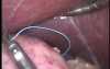 Laparoscopic Gastric Sleeve Plication of Greater Curvature