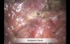 Robotic Cylindrical Abdominoperineal Resection With Transabdominal Levator Transection