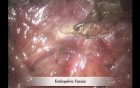 Robotic Cylindrical Abdominoperineal Resection With Transabdominal Levator Transection