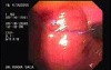 Intraluminal Endoscopic Suturing - Creation of the First Gastroplicature