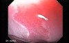 Barrett Esophagus - endoscopic view  (4 of 9)