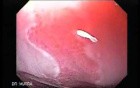 Barrett Esophagus - endoscopic view  (4 of 9)