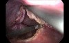 Laparoscopic deroofing of simple liver cyst