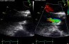 A Fibrous Membrane Below the Aortic Valve - a Case of Subaortic Membrane