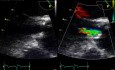 A Fibrous Membrane Below the Aortic Valve - a Case of Subaortic Membrane
