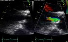A Fibrous Membrane Below the Aortic Valve - a Case of Subaortic Membrane
