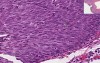 Cervix - Squamous Metaplasia